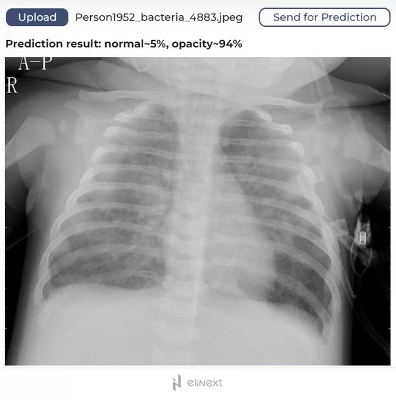 Pneumonie-Diagnosetool