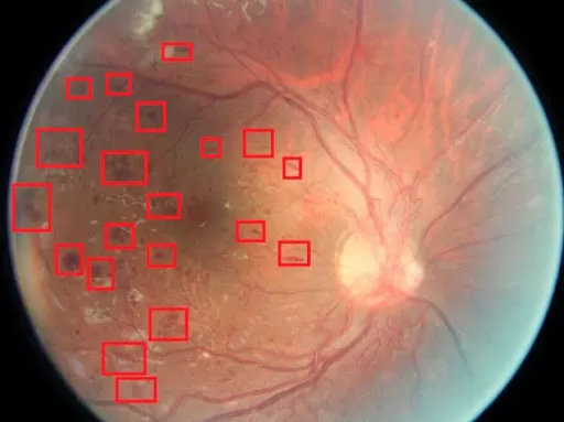 Software Produkt zur Klassifizierung diabetischer Retinopathie in 4 Stadien